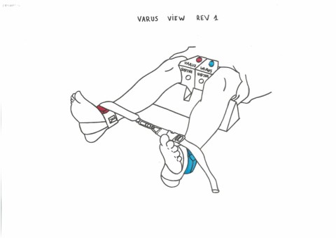 OSSKAR positions the lower limb for valgus and varus stress imaging of the knee using a standardised technique, for assessment of the pattern and severity within the medial and lateral compartments of the adult knee.
For more information: https://www.askorn.bzh/en/osskar/